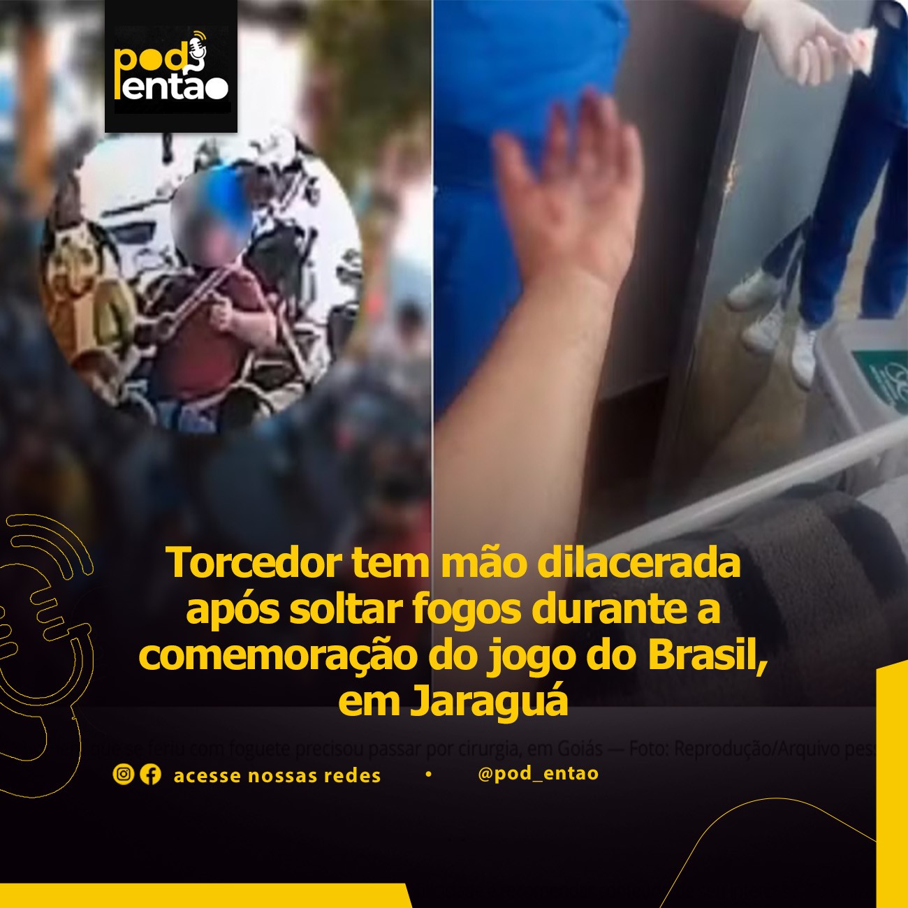 Torcedor tem mão dilacerada após soltar fogos durante a comemoração do jogo do Brasil, em Jaraguá